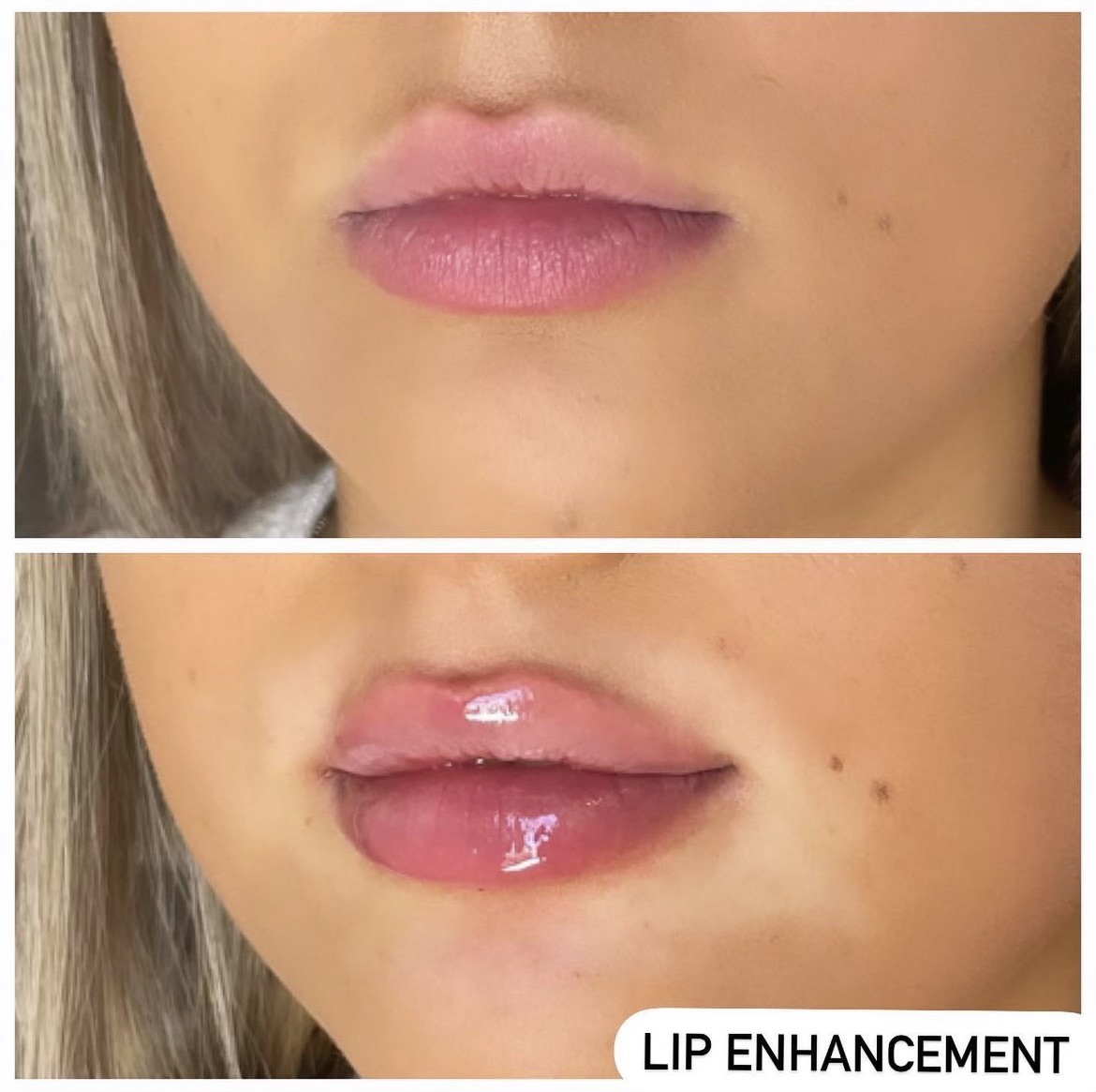 lip enhancement -cosmetic injectables
